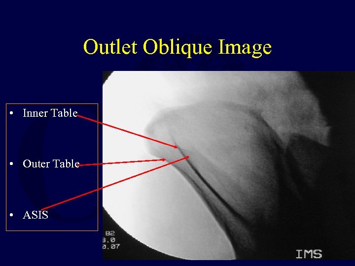 Outlet Oblique Image • Inner Table • Outer Table • ASIS 