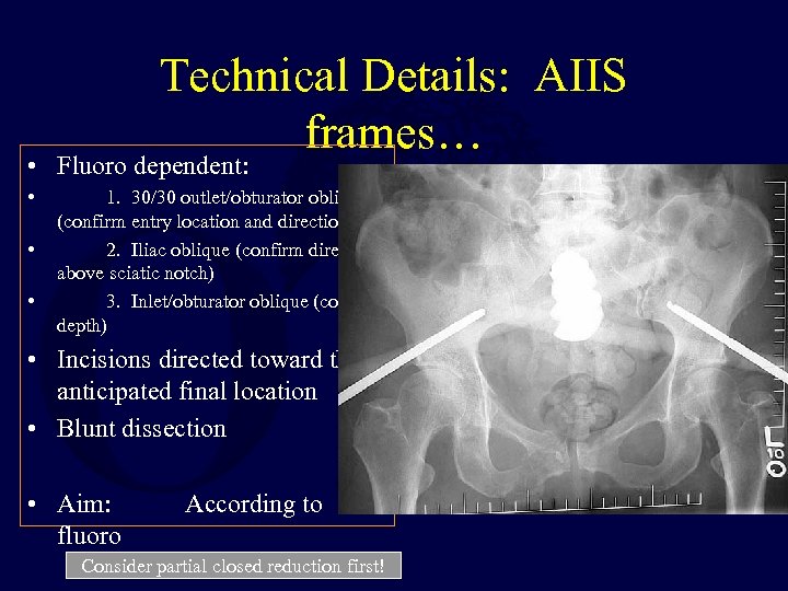 Technical Details: AIIS frames… • Fluoro dependent: • • • 1. 30/30 outlet/obturator oblique