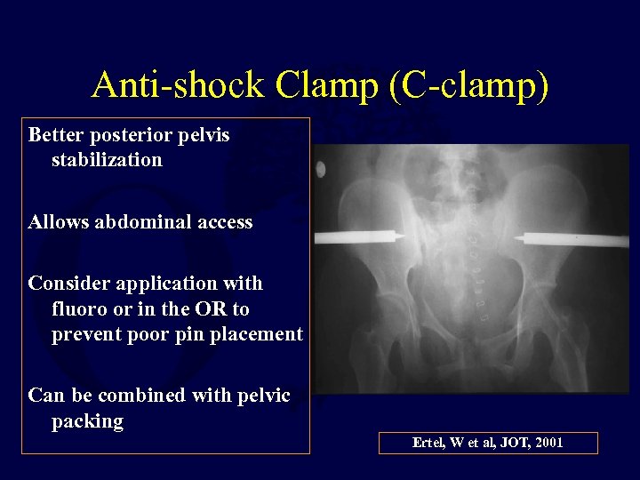 Anti-shock Clamp (C-clamp) Better posterior pelvis stabilization Allows abdominal access Consider application with fluoro