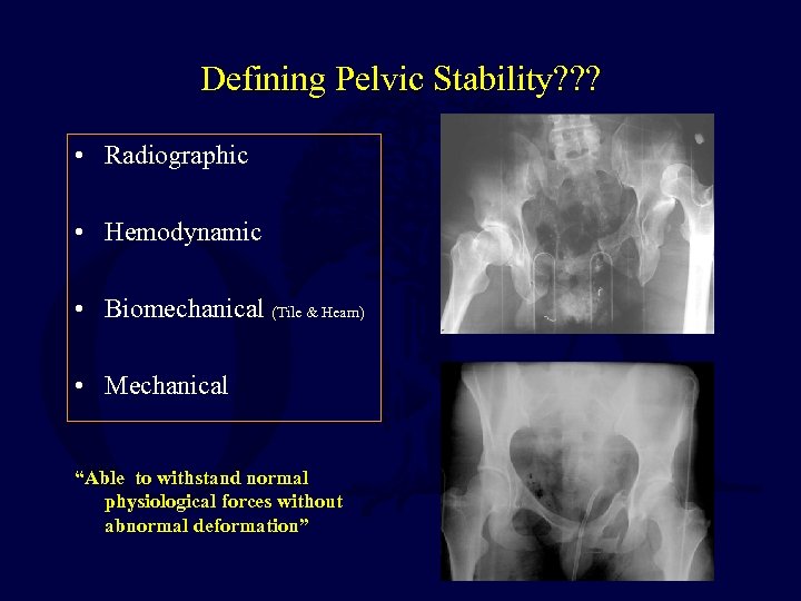 Defining Pelvic Stability? ? ? • Radiographic • Hemodynamic • Biomechanical (Tile & Hearn)