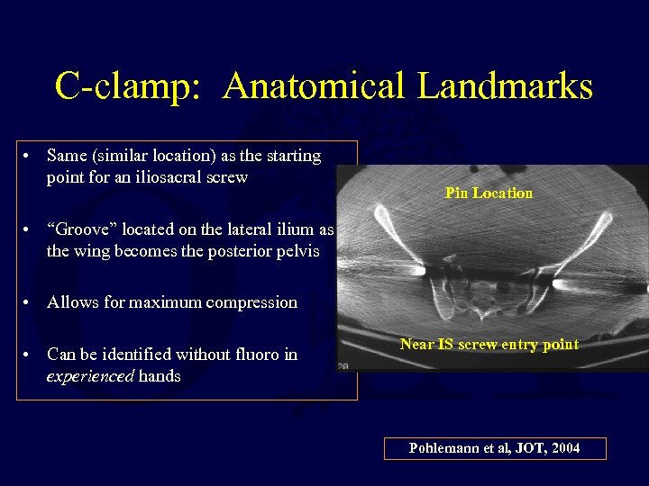 C-clamp: Anatomical Landmarks • Same (similar location) as the starting point for an iliosacral