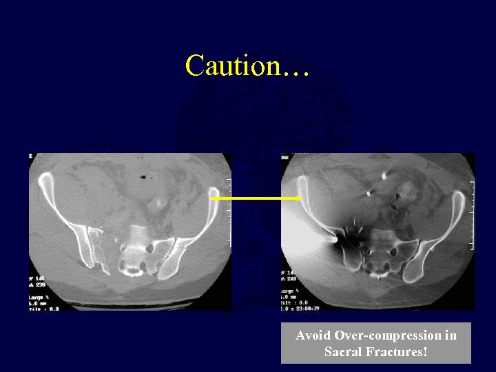 Caution… Avoid Over-compression in Sacral Fractures! 