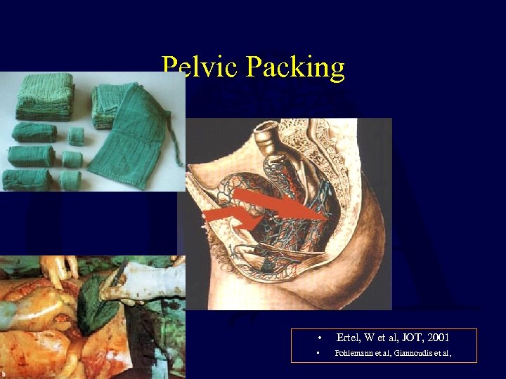 Pelvic Packing • Ertel, W et al, JOT, 2001 • Pohlemann et al, Giannoudis