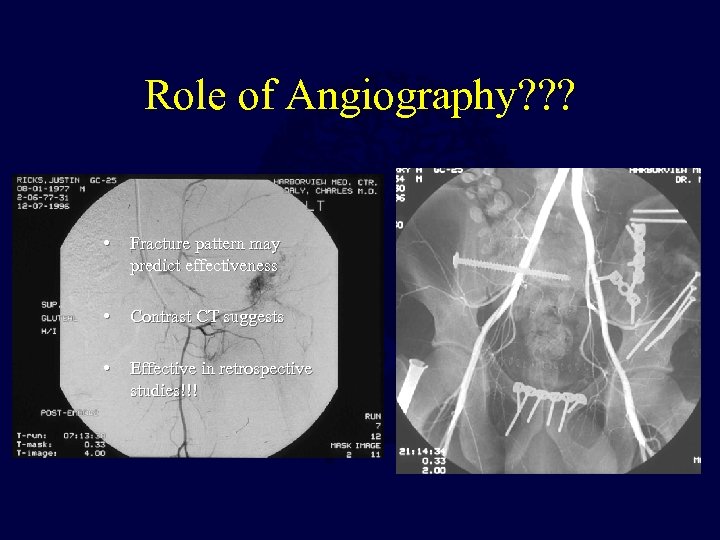 Role of Angiography? ? ? • Fracture pattern may predict effectiveness • Contrast CT