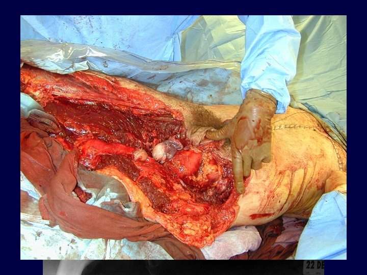 Acute Hemipelvectomy…. 