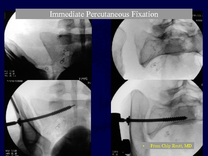 Immediate Percutaneous Fixation • From Chip Routt, MD 