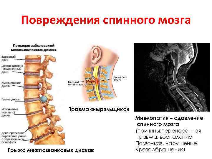 Повреждения спинного мозга Травма «ныряльщика» Грыжа межпозвонковых дисков Миелопатия – сдавление спинного мозга (причины: