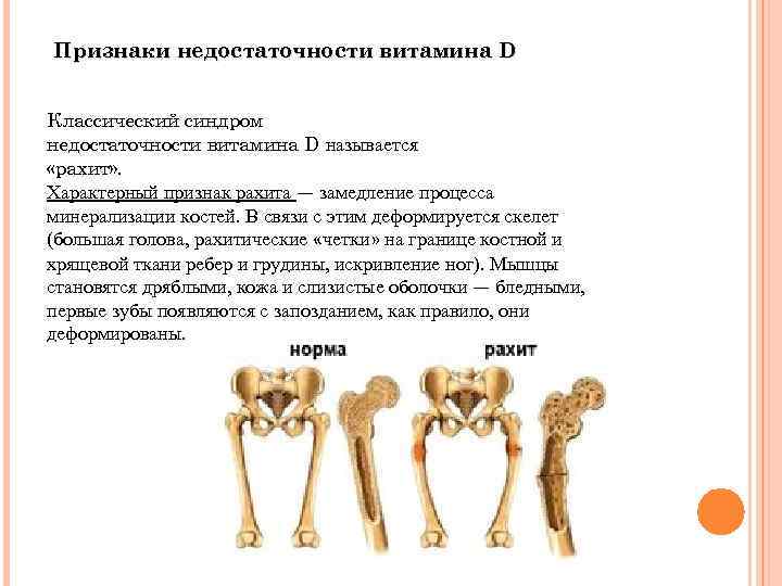 Признаки недостаточности витамина D Классический синдром недостаточности витамина D называется «рахит» . Характерный признак