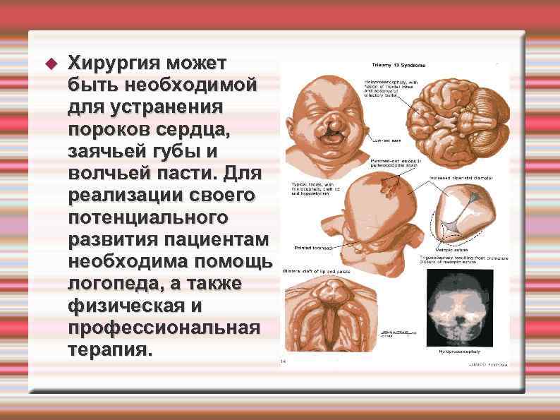 Трисомия х презентация