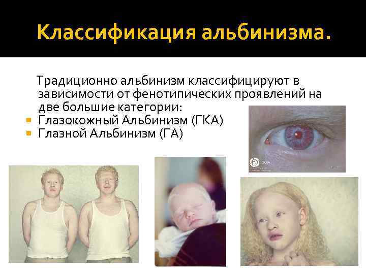 Классификация альбинизма. Традиционно альбинизм классифицируют в зависимости от фенотипических проявлений на две большие категории: