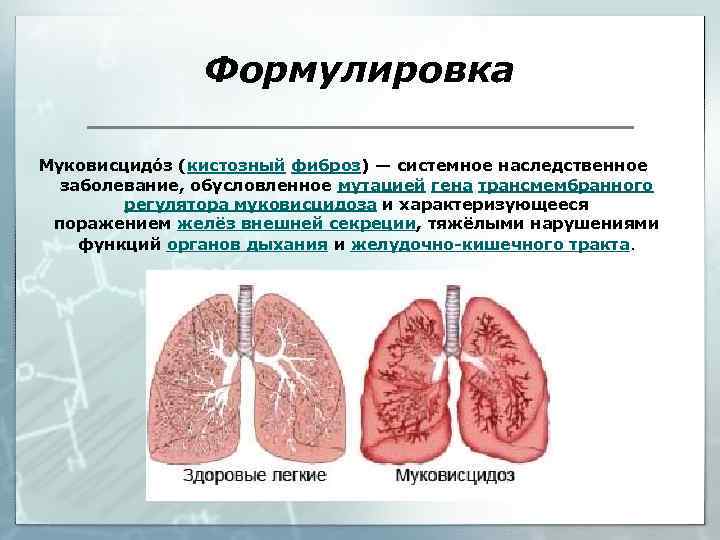 Формулировка Муковисцидóз (кистозный фиброз) — системное наследственное заболевание, обусловленное мутацией гена трансмембранного регулятора муковисцидоза