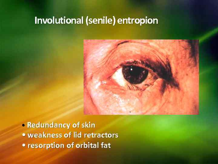 Involutional (senile) entropion • Redundancy of skin • weakness of lid retractors • resorption