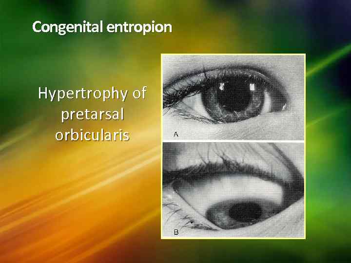 Congenital entropion Hypertrophy of pretarsal orbicularis 