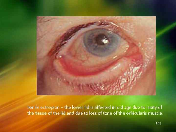 Senile ectropion – the lower lid is affected in old age due to laxity