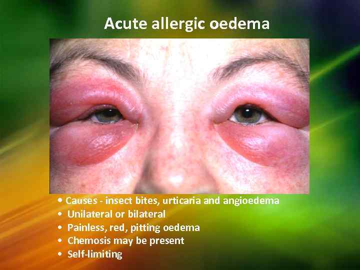 Acute allergic oedema • Causes - insect bites, urticaria and angioedema • • Unilateral