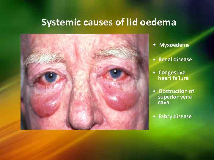 Systemic causes of lid oedema • Myxoedema • Renal disease • Congestive heart failure
