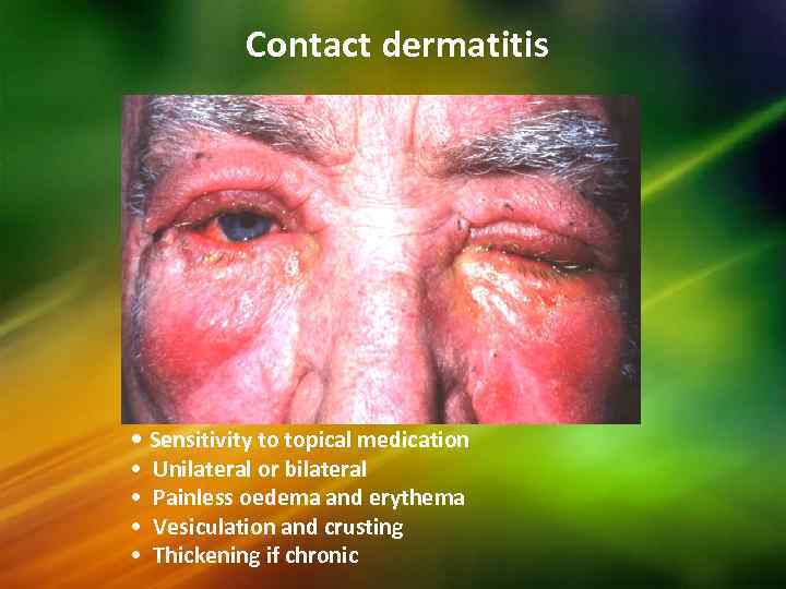 Contact dermatitis • Sensitivity to topical medication • • Unilateral or bilateral Painless oedema