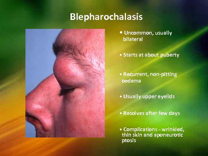 Blepharochalasis • Uncommon, usually bilateral • Starts at about puberty • Recurrent, non-pitting oedema