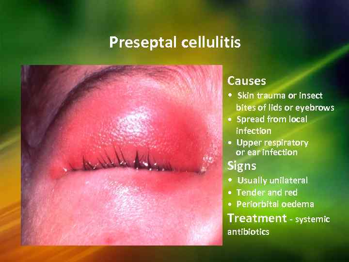 Preseptal cellulitis Causes • Skin trauma or insect bites of lids or eyebrows •