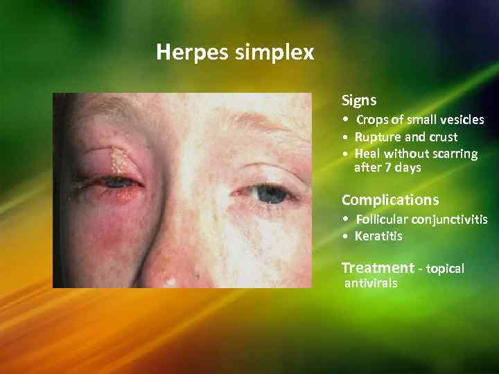 Herpes simplex Signs • Crops of small vesicles • Rupture and crust • Heal