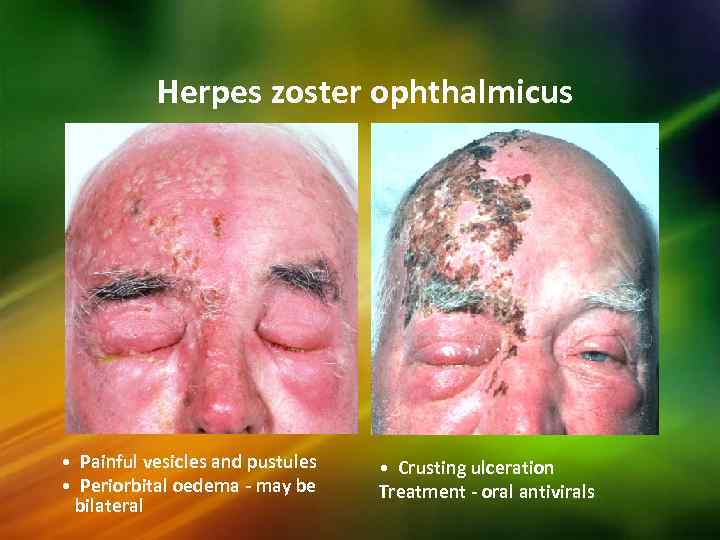 Herpes zoster ophthalmicus • Painful vesicles and pustules • Periorbital oedema - may be