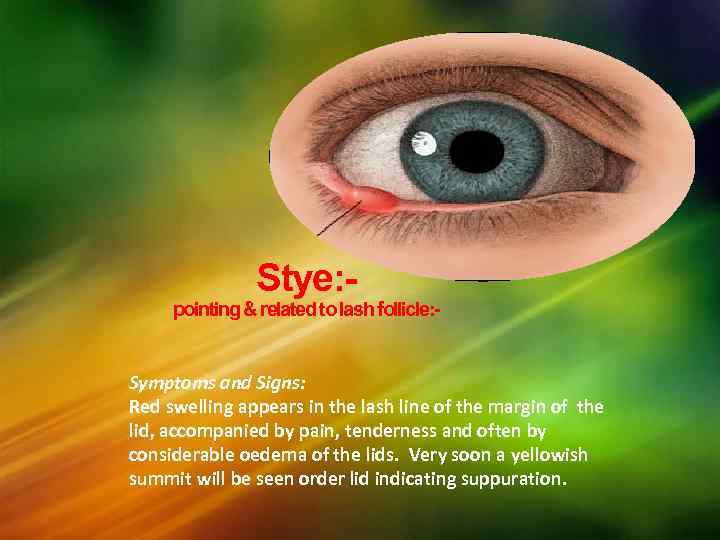 Stye: - pointing & related to lash follicle: Symptoms and Signs: Red swelling appears