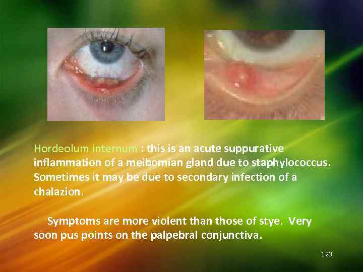Hordeolum internum : this is an acute suppurative inflammation of a meibomian gland due