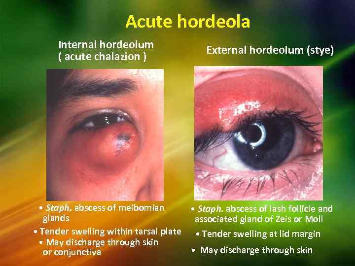 Acute hordeola Internal hordeolum ( acute chalazion ) External hordeolum (stye) • Staph. abscess