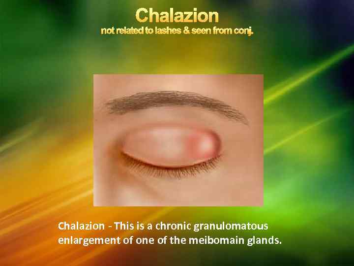 Chalazion - This is a chronic granulomatous enlargement of one of the meibomain glands.