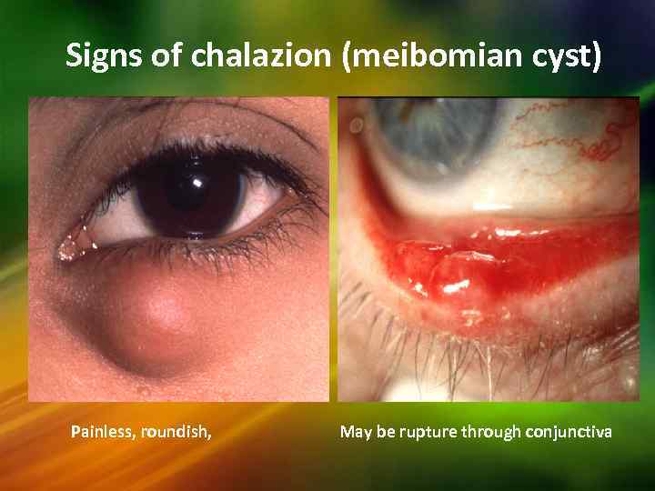 Signs of chalazion (meibomian cyst) Painless, roundish, May be rupture through conjunctiva 