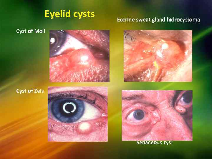 Eyelid cysts Eccrine sweat gland hidrocystoma Cyst of Moll Cyst of Zeis Sebaceous cyst