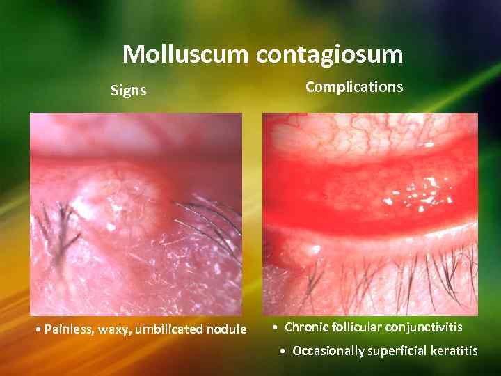 Molluscum contagiosum Signs • Painless, waxy, umbilicated nodule Complications • Chronic follicular conjunctivitis •