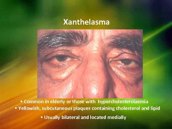 Xanthelasma • Common in elderly or those with hypercholesterolaemia • Yellowish, subcutaneous plaques containing