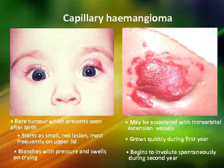 Capillary haemangioma • Rare tumour which presents soon after birth • Starts as small,