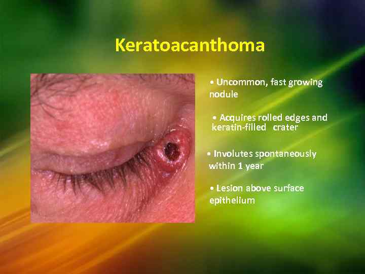 Keratoacanthoma • Uncommon, fast growing nodule • Acquires rolled edges and keratin-filled crater •