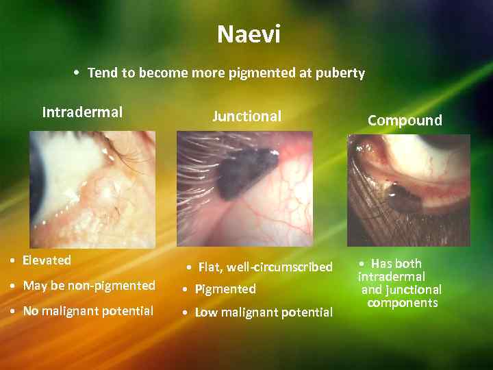 Naevi • Tend to become more pigmented at puberty Intradermal • Elevated Junctional •