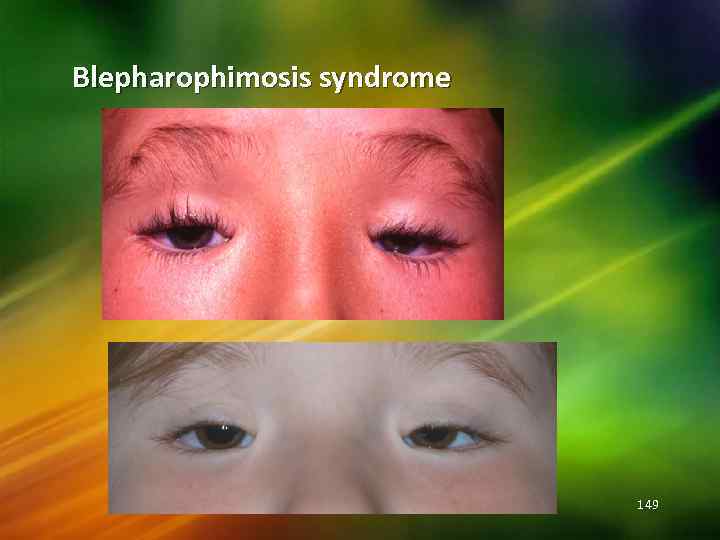 Blepharophimosis syndrome 149 