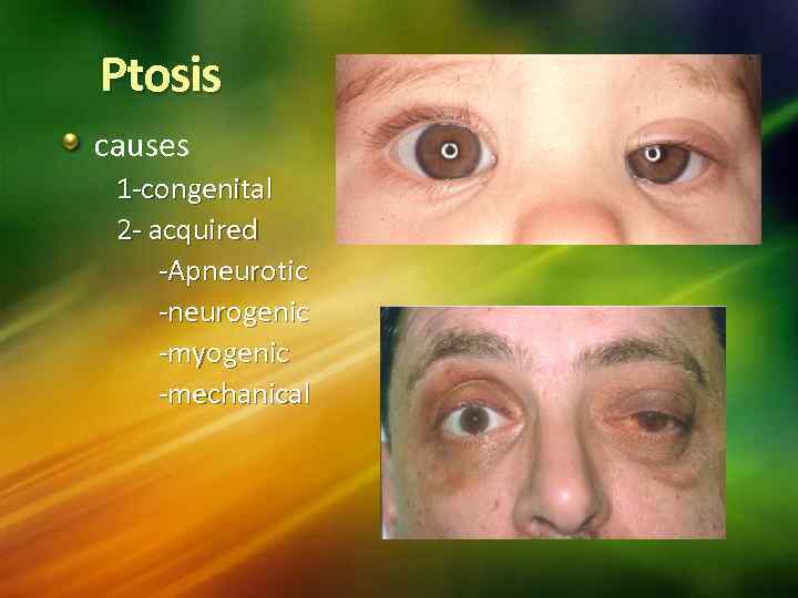 Ptosis causes 1 -congenital 2 - acquired -Apneurotic -neurogenic -myogenic -mechanical 