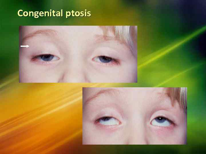 Congenital ptosis 