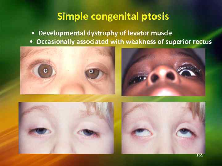 Simple congenital ptosis • Developmental dystrophy of levator muscle • Occasionally associated with weakness