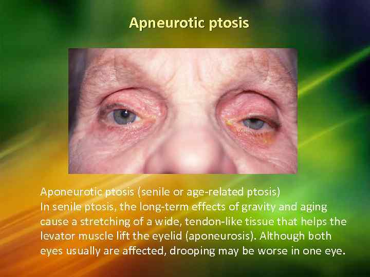 Apneurotic ptosis Aponeurotic ptosis (senile or age-related ptosis) In senile ptosis, the long-term effects