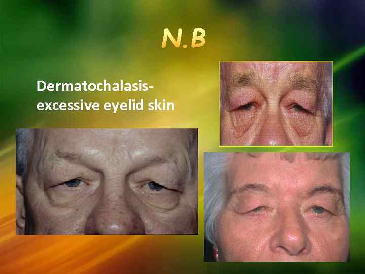 Dermatochalasisexcessive eyelid skin 