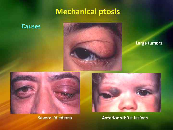 Mechanical ptosis Causes Large tumors Severe lid edema Anterior orbital lesions 