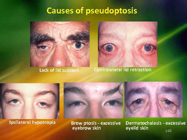 Causes of pseudoptosis Lack of lid support Ipsilateral hypotropia Contralateral lid retraction Brow ptosis