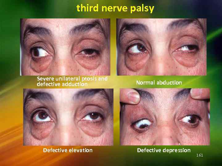 third nerve palsy Severe unilateral ptosis and defective adduction Defective elevation Normal abduction Defective