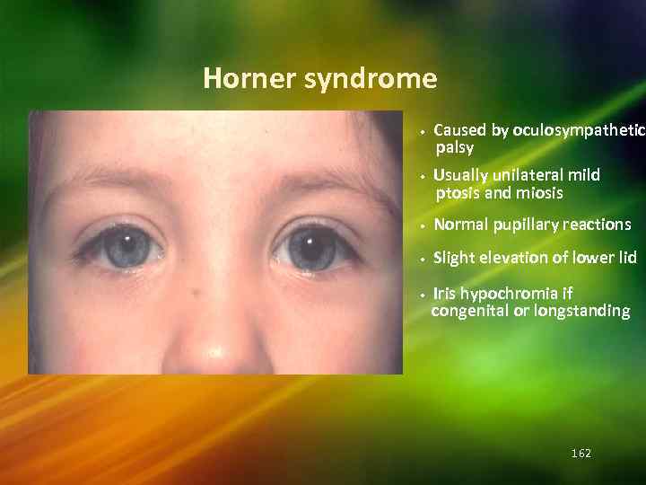 Horner syndrome • • Caused by oculosympathetic palsy Usually unilateral mild ptosis and miosis