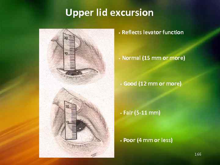 Upper lid excursion • Reflects levator function • Normal (15 mm or more) •