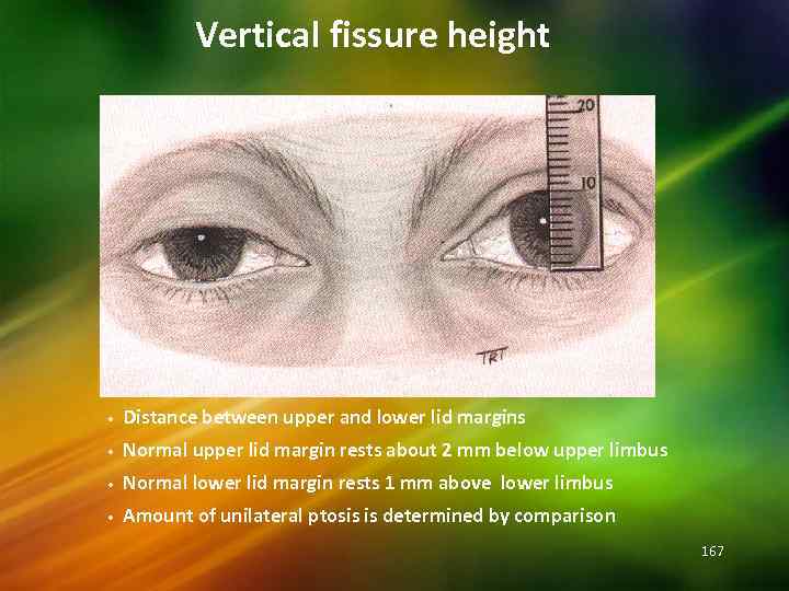 Vertical fissure height • Distance between upper and lower lid margins • Normal upper
