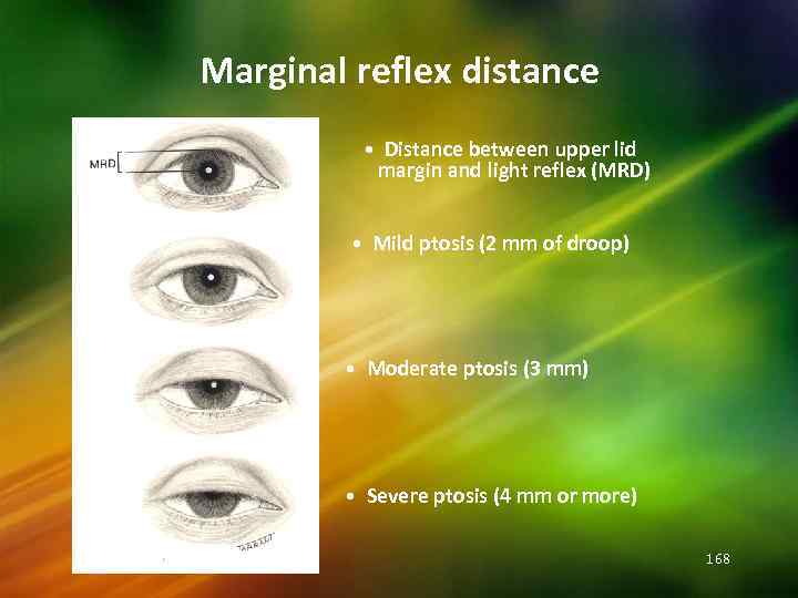 Marginal reflex distance • Distance between upper lid margin and light reflex (MRD) •