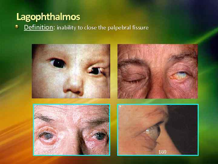 Lagophthalmos Definition: inability to close the palpebral fissure 169 